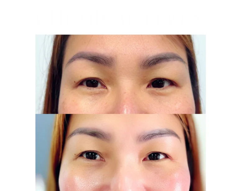 Hyaluronic Acid Fillers Before and After Result- Jules Aesthetics