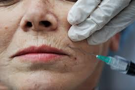 From Crease to Kiss: What Causes Lip Wrinkles and How to Treat Them