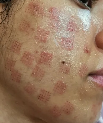 Waffles imprinted in your skin